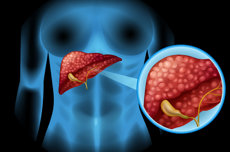 Liver FibroScan